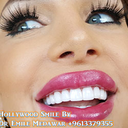 Composite Veneers Lebanon