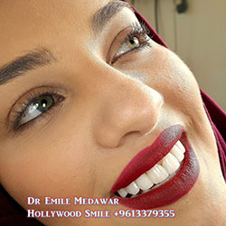 Composite Veneers Lebanon