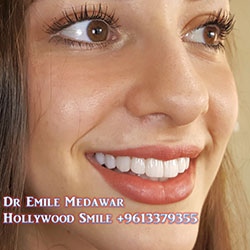 Composite Veneers Lebanon