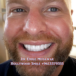 Composite Veneers Lebanon