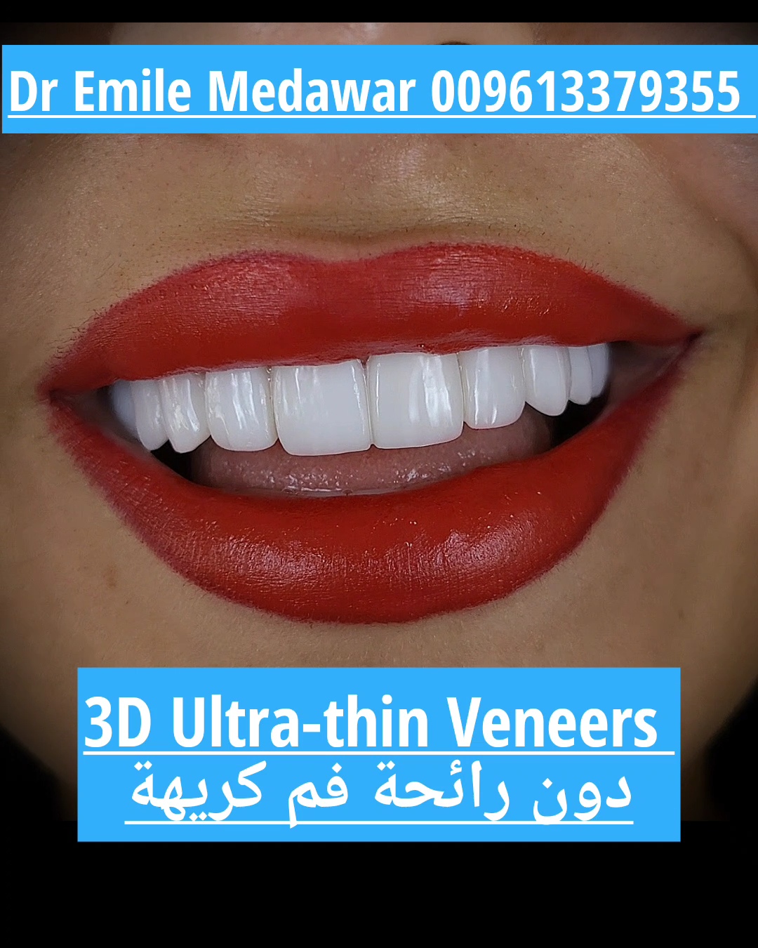Dental Implants in Beirut lebanon