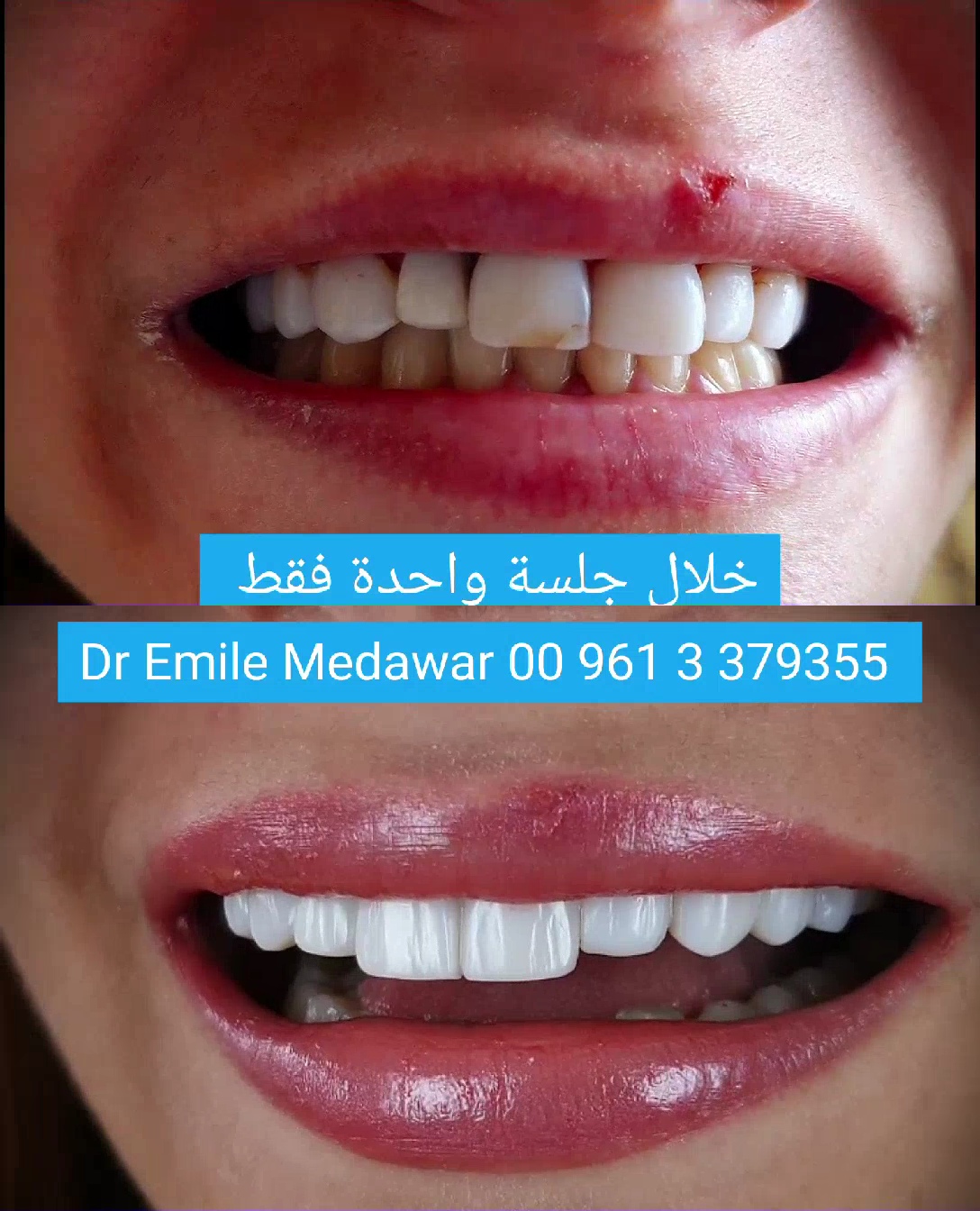 ابتسامة قبل وبعد الفينير في لبنان بيروت