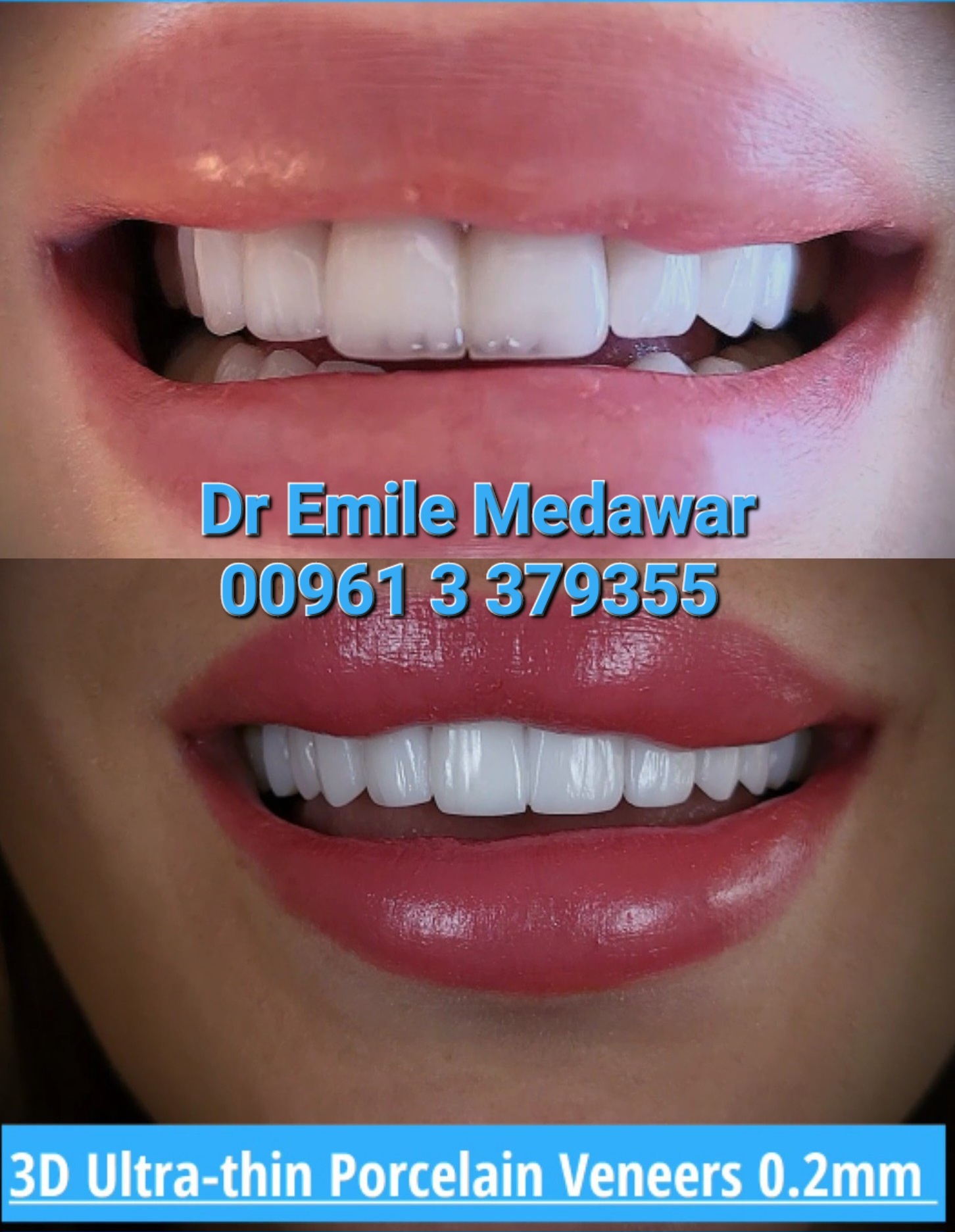 ابتسامة قبل وبعد الفينيرز تجميل اسنان لبنان بيروت