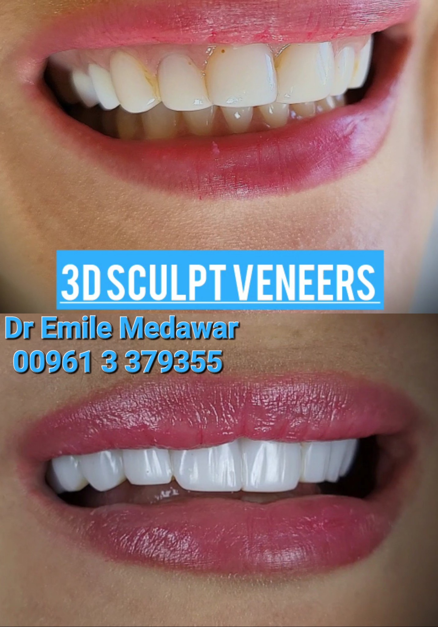 ابتسامة  هوليود قبل وبعد الفينير التركيبي